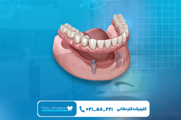 مقاومت کاشت دندان و دندان مصنوعی مقاومت کاشت دندان و دندان مصنوعی