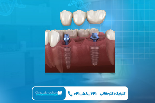ایمپلنت بهتر است یا دندان مصنوعی ایمپلنت بهتر است یا دندان مصنوعی