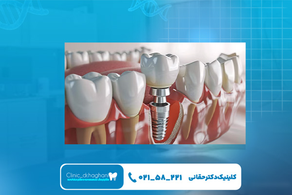 ایمپلنت دندان با تجهیزات پیشرفته دیجیتال