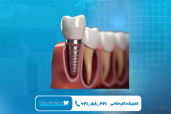 قیمت ایمپلنت دندان در تهران