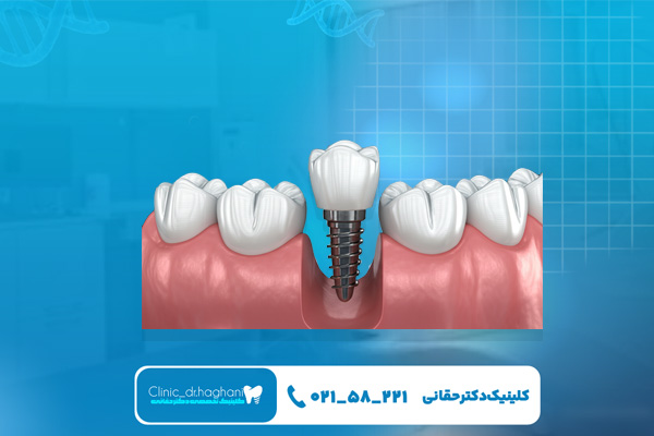 مراحل انجام کاشت ایمپلنت دندان در تهران