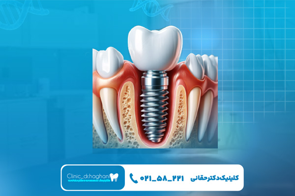 ایمپلنت دندان در تهران