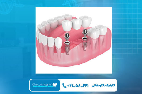 ایمپلنت دندان در شرق تهران