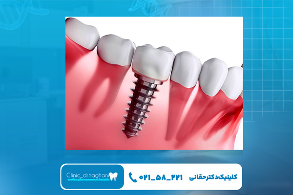 مراحل انجام کاشت ایمپلنت دندان
