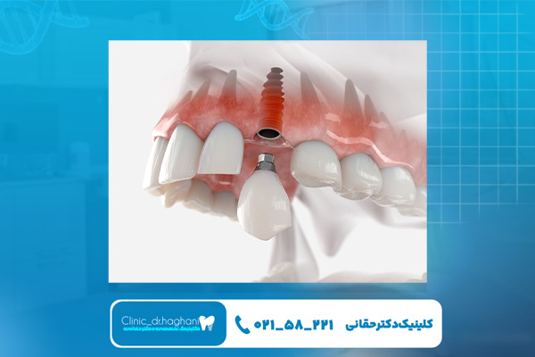 ایمپلنت قسطی در کلینیک دندانپزشکی دکتر حقانی ایمپلنت قسطی در کلینیک دندانپزشکی دکتر حقانی