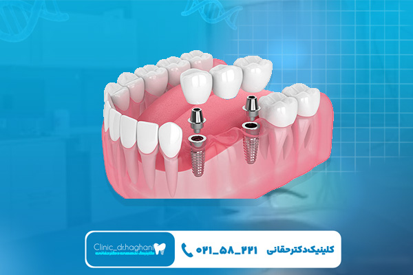 مراحل ایمپلنت دندان مراحل ایمپلنت دندان