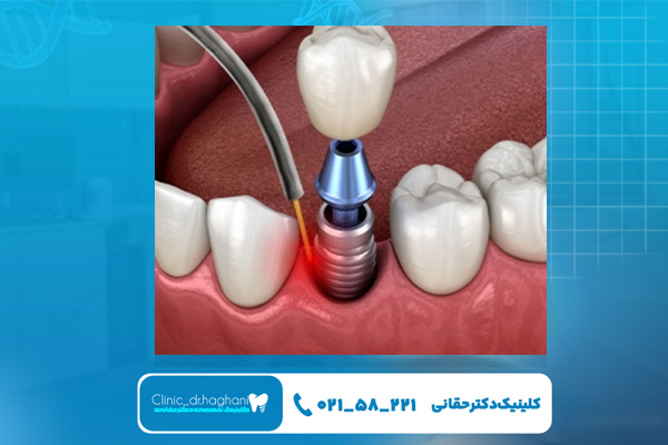 ایمپلنت دندان فوری با لیزر