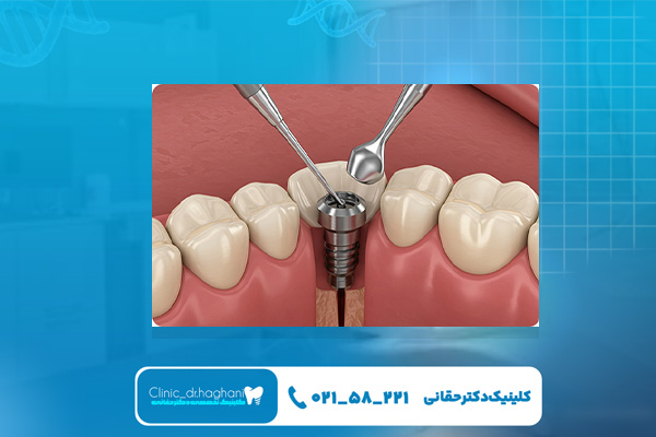 ایمپلنت دندان فوری با لیزر