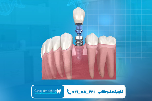 ایمپلنت دندان چند سال عمر می کند؟