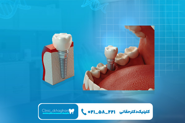 ایمپلنت دندان چند سال عمر می کند؟