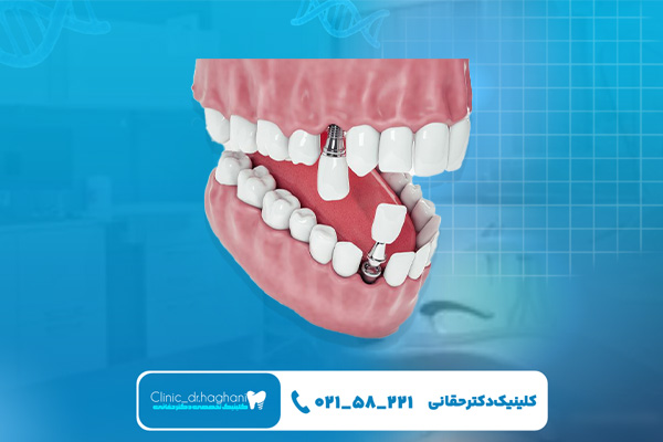 ایمپلنت دندان چند سال عمر می کند؟