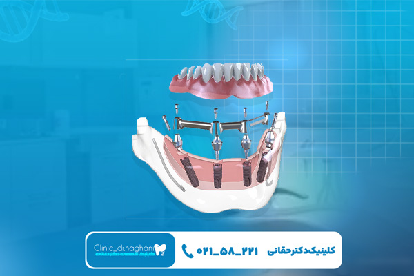 ایمپلنت دیجیتال قسطی