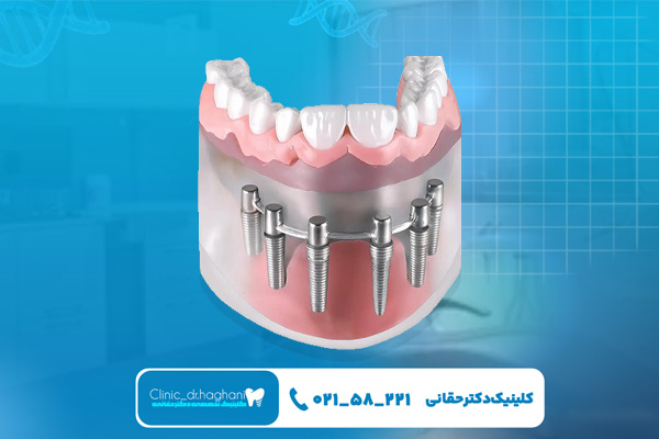  قیمت ایمپلنت دیجیتال اقساطی