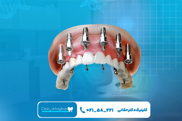  طرح اقساطی در مراکز دندانپزشکی