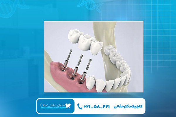 مزیت‌های ایمپلنت دیجیتال