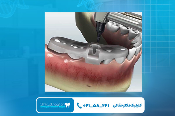 ایمپلنت دیجیتال در تهران