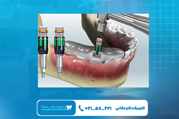 ایمپلنت دیجیتال در تهران