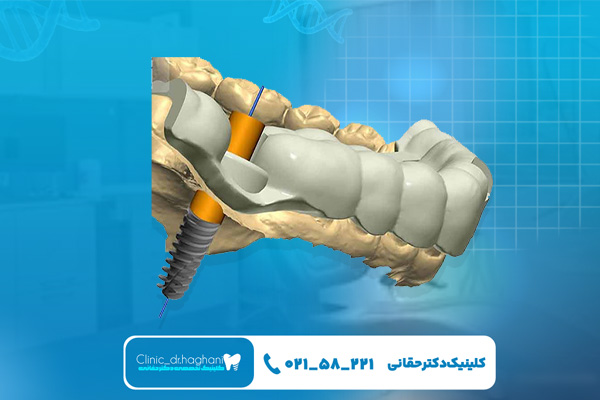 ایمپلنت دیجیتال چقدر هزینه دارد؟