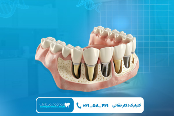 کیفیت مواد ایمپلنت سوئیسی