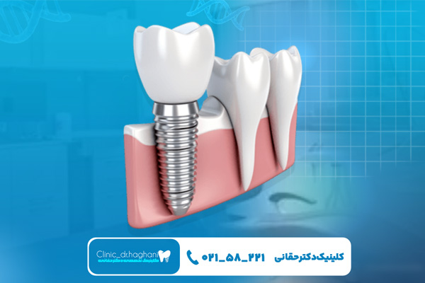ایمپلنت سوئیسی دندان در تهران