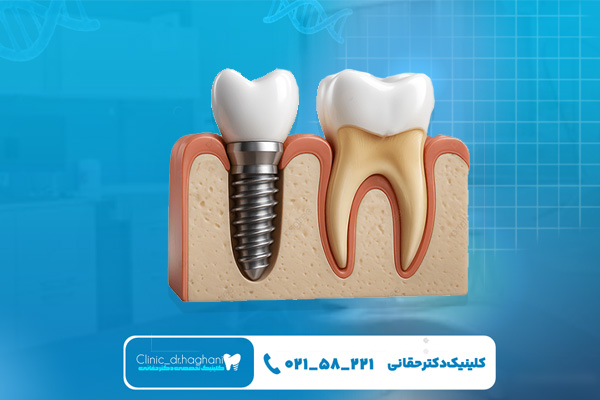 مقایسه بین ایمپلنت سوئیسی با سایر برندها