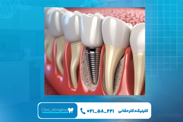 مراحل مختلف  ایمپلنت فوری