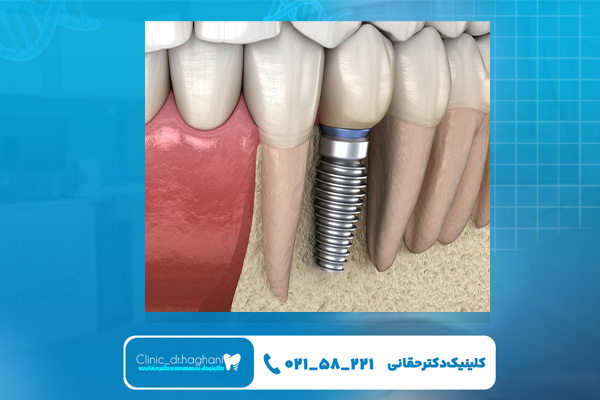 شرایط مناسب برای انجام ایمپلنت فوری
