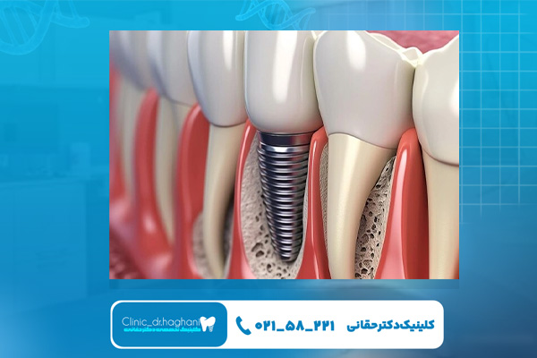 ایمپلنت فوری