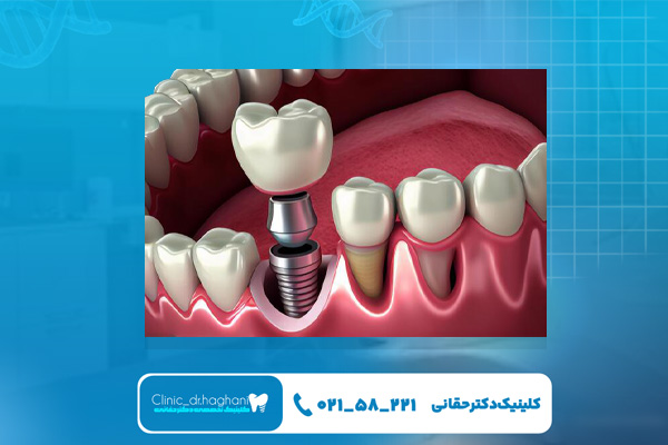 افراد واجد شرایط انجام ایمپلنت فوری افراد واجد شرایط انجام ایمپلنت فوری