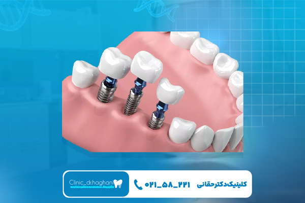 مزایای کاشت ایمپلنت نسبت به سایر روشها مزایای کاشت ایمپلنت نسبت به سایر روشها