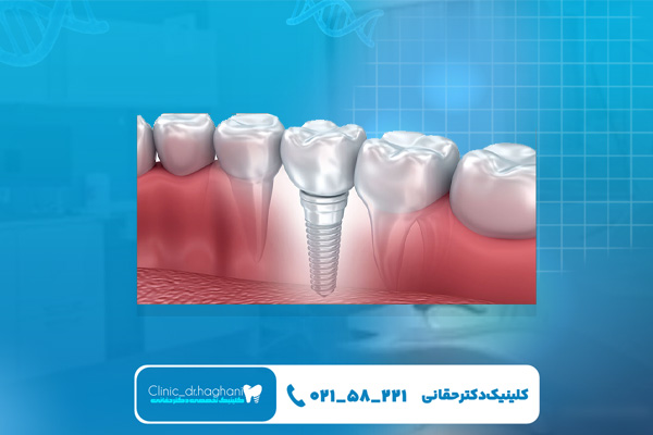 هزینه کاشت ایمپلنت فوری در شمال تهران هزینه کاشت ایمپلنت فوری در شمال تهران