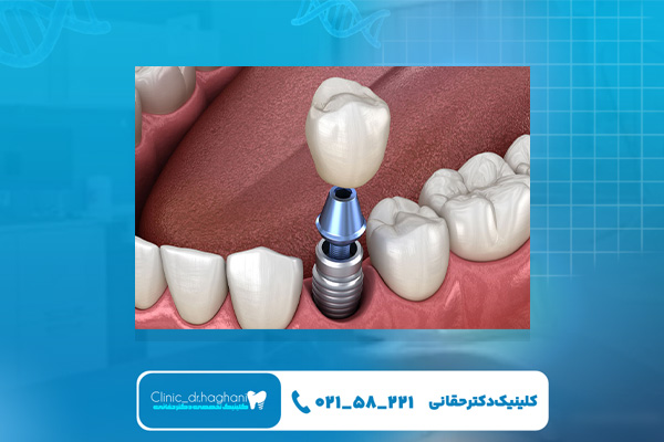 بهترین کلینیک ایمپلنت فوری در شمال تهران بهترین کلینیک ایمپلنت فوری در شمال تهران