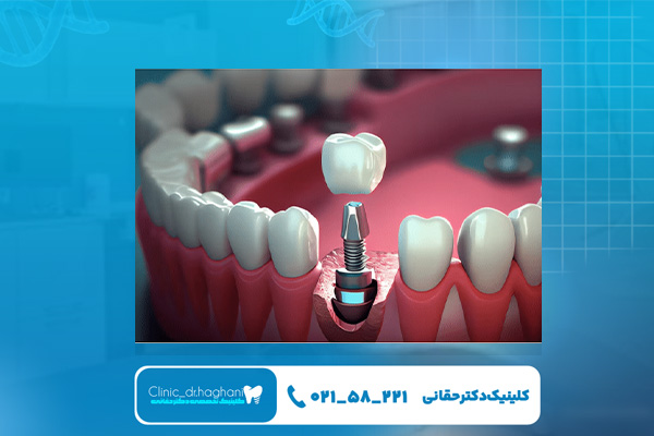 افراد واجد شرایط ایمپلنت فوری افراد واجد شرایط ایمپلنت فوری