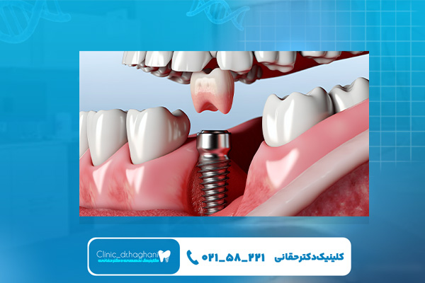 ایمپلنت فوری غرب تهران ایمپلنت فوری غرب تهران