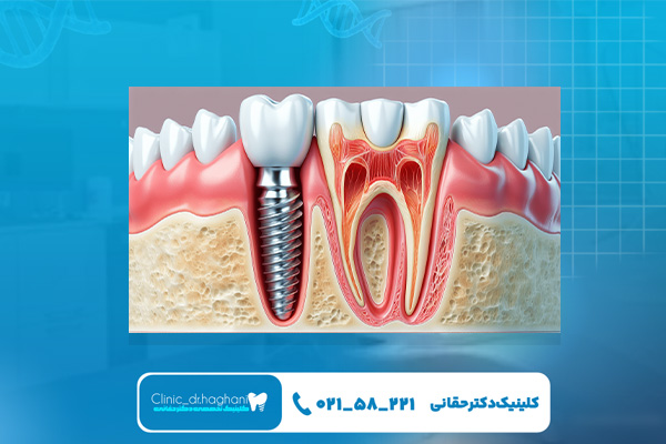 مزیتهای ایمپلنت فوری مزیتهای ایمپلنت فوری