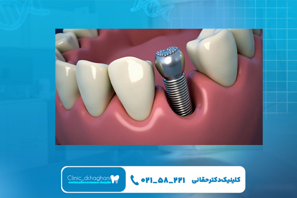 تصویربرداری سهبعدی در کاشت ایمپلنت فوری تصویربرداری سهبعدی در کاشت ایمپلنت فوری