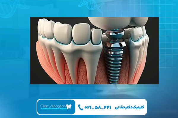 کاربرد لیزر در درمانهای ایمپلنت دندان فوری کاربرد لیزر در درمانهای ایمپلنت دندان فوری