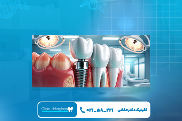 ایمپلنت فوری مرکز تهران ایمپلنت فوری مرکز تهران