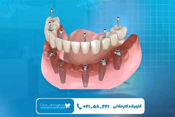 مرحله کاشت ایمپلنت فک پایین