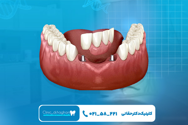 اصلی‌ترین عوارض ایمپلنت فک پایین