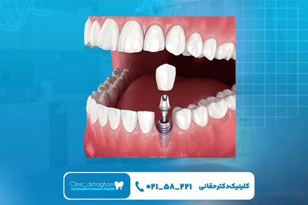 ایمپلنت چند سال ماندگاری دارد ایمپلنت چند سال ماندگاری دارد