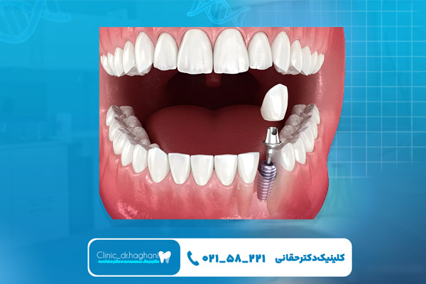 عوامل موثر بر طول عمر ایمپلنت عوامل موثر بر طول عمر ایمپلنت