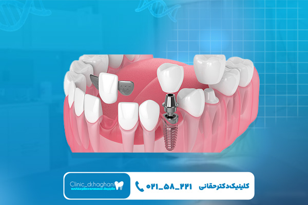 عوامل کمتر شدن طول عمر ایمپلنت دندان عوامل کمتر شدن طول عمر ایمپلنت دندان