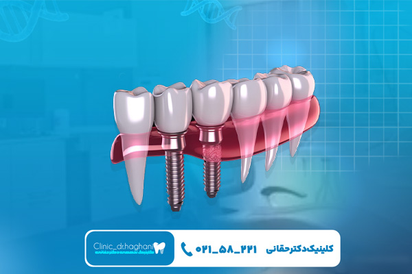 معرفی ایمپلنت دندان چینی معرفی ایمپلنت دندان چینی
