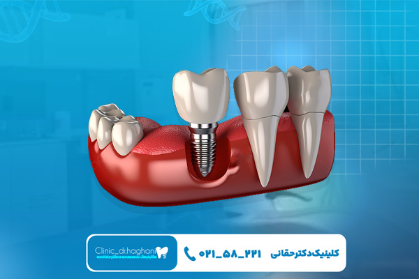 نکات ضعف ایمپلنت دندان چینی نکات ضعف ایمپلنت دندان چینی