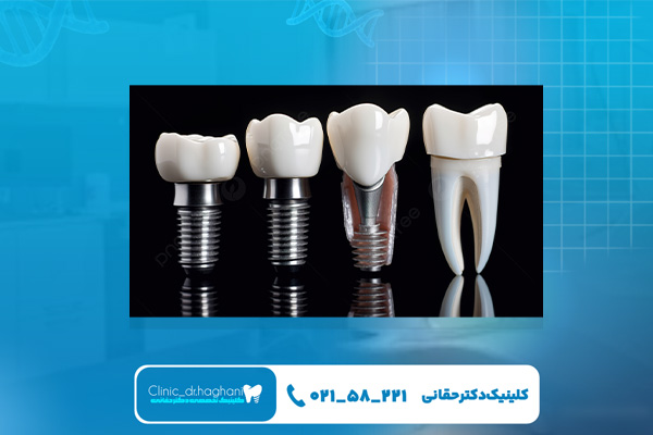 ایمپلنت چینی خوب است یا نه؟ ایمپلنت چینی خوب است یا نه؟