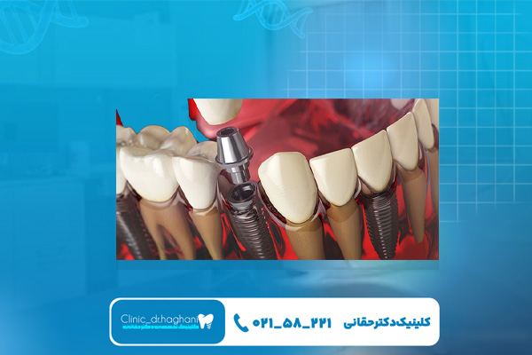 انتخاب بهترین ایمپلنت انتخاب بهترین ایمپلنت