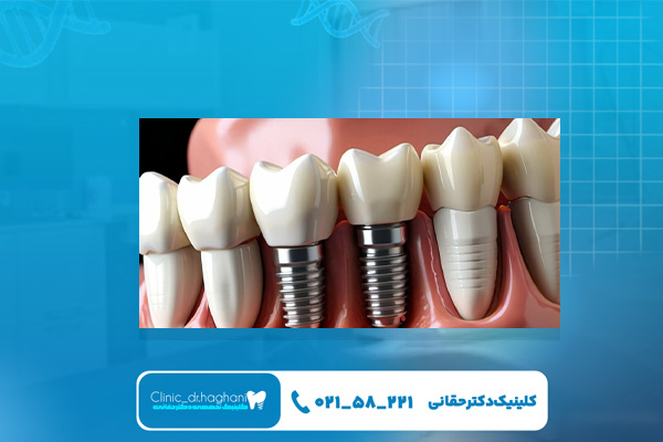  کلینیک تخصصی دکتر حقانی برای ایمپلنت یک روزه