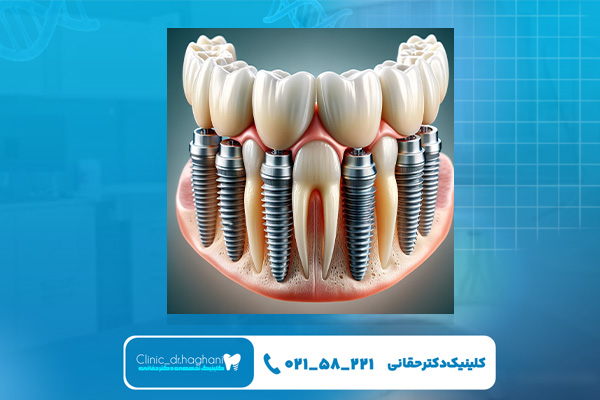 مراحل انجام ایمپلنت فوری دندان در یک روز