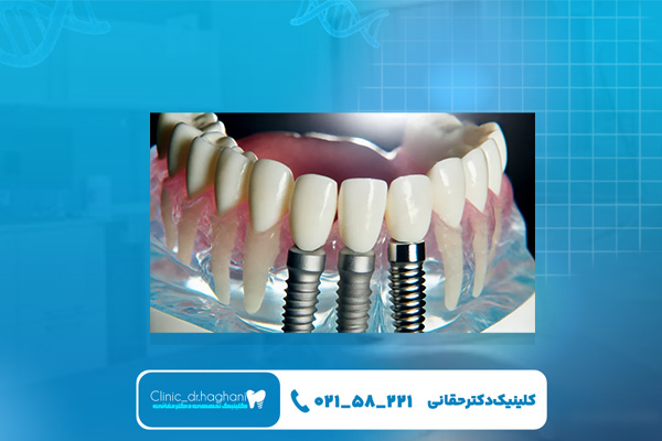 ایمپلنت یک روزه غرب تهران